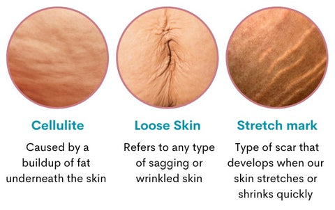 AEXZR™ Stretchmark Repair Cream