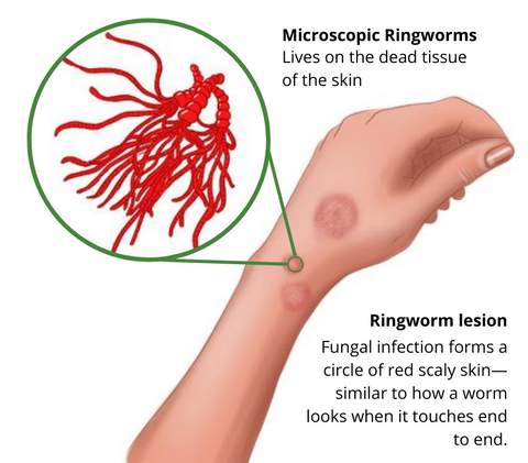 TineaCure™ Bio Corporis Cream