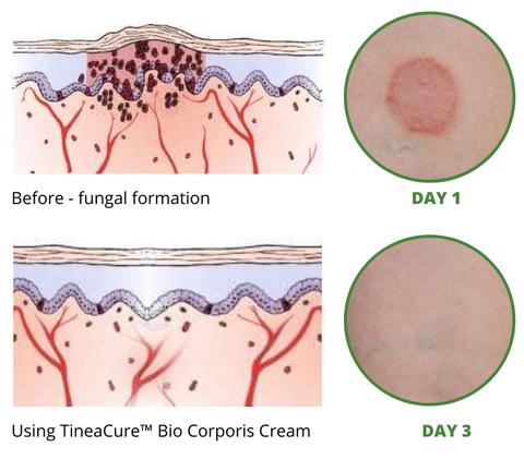 TineaCure™ Bio Corporis Cream