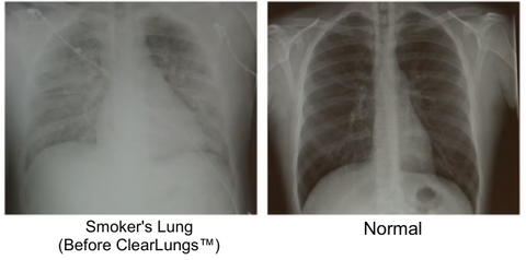 ClearLungs™ Respiratory Care Drops