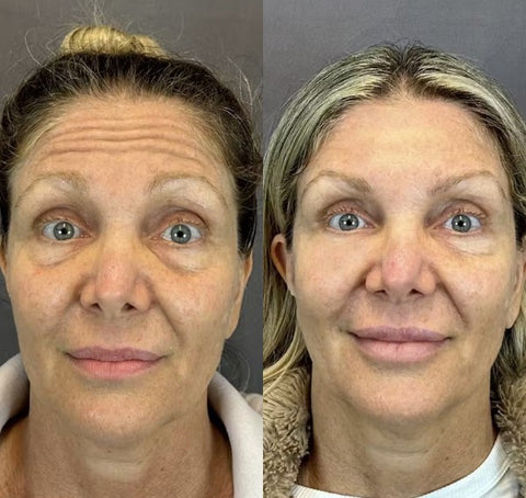 Patch anti-rides frontal DermaBliss™