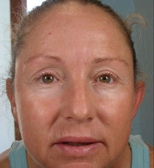 FaceLift™ Anti-wrinkle Patch