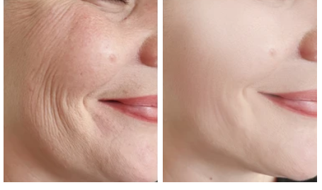 FaceLift™ Anti-wrinkle Patch