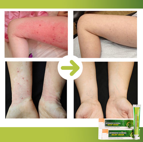 Intensive Eczema Relief Cream