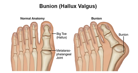 Orthoes™ Bunion Relief Socks - Conferencm