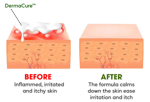 DermaCure™ Shingles Treatment Cream