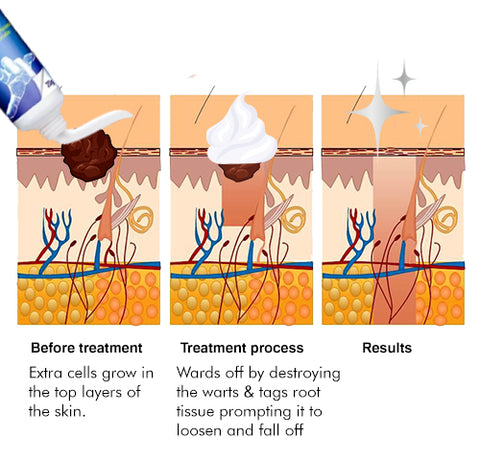 SkinDeluxe™ Wart-Removal Ointment