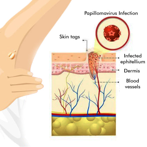 WipeOff™ Neurofibroma & Moles Remover