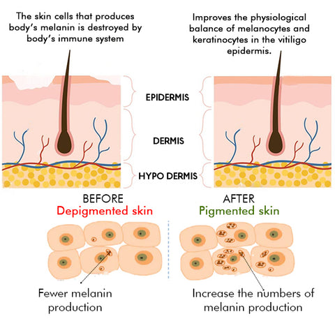 SpotCare™ Vitiligo Therapeutic Cream