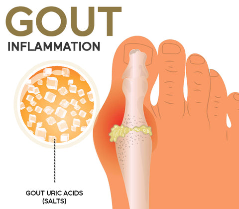 AEXZR™ Roll-On Cooling Gout Cure