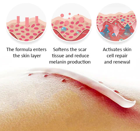 SkinPro™ Scar Removal Gel