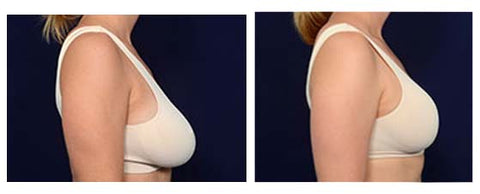 CC™ Breast Enhancement Patch 