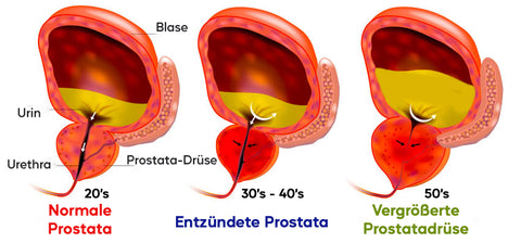 VCare™ Prostata-테라피 Unterwäsche