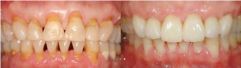 DentiZen™ Gum Therapy Gel