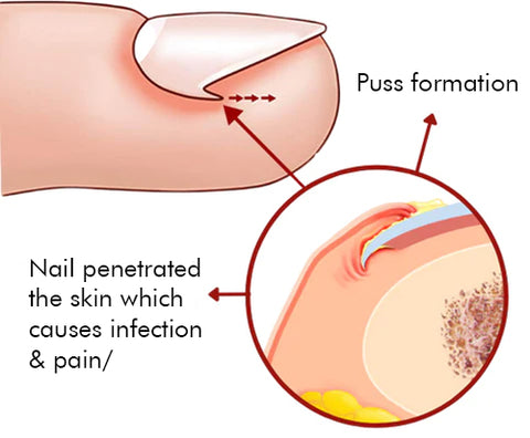 Nailcare™ Ingrown Toe Nail Drops