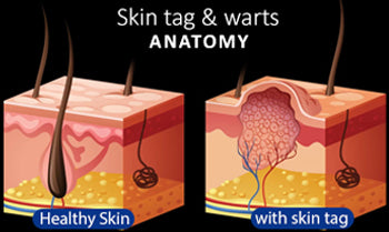 Wart Removal Sterile Clip