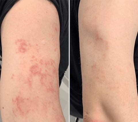 Dermax™ Psoriasis Treatment Spray