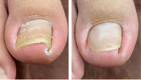 Nailcare™ Ingrown Toe Nail Drops 