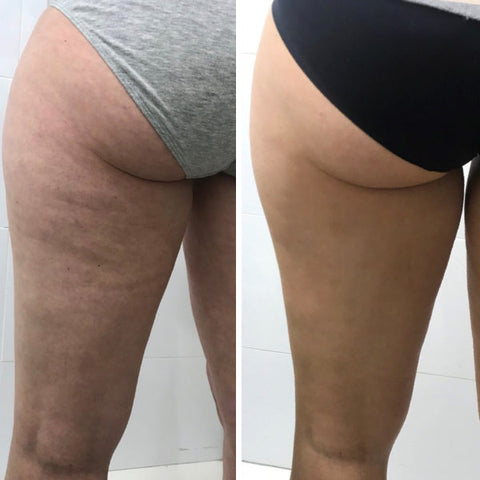 Skinnies™ Anti-Cellulite Firming Patch