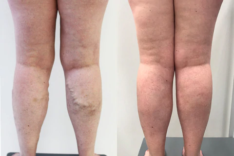 VenaCure™ Varicose Vein Cream
