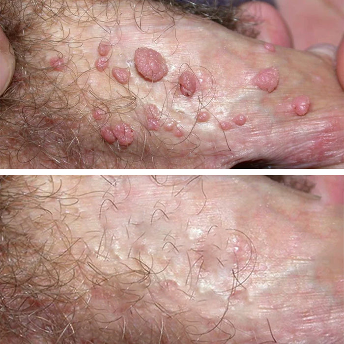 AEXZR® Herbal Genital Skin Treatment Cream