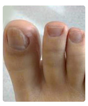 NailCare™ Toe Nail Treatment Gel