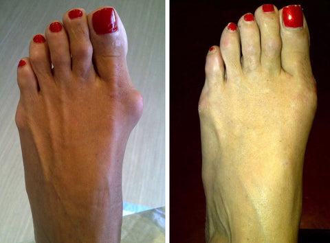 Fivfivgo™ Dr.Fit Silikon-Bunion-Korrektor