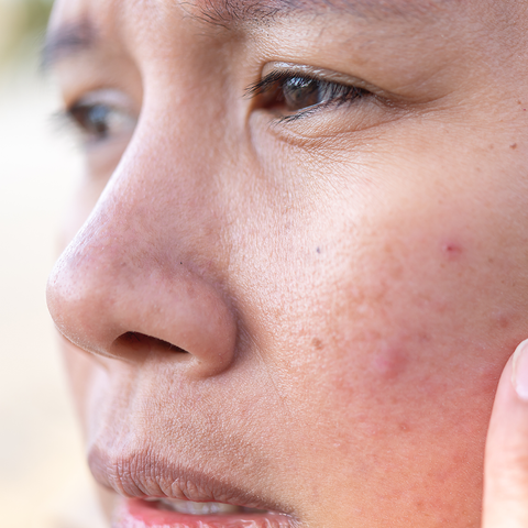 IMAGE OF WOMAN WIth MENOPAUSAL ACNE | anti aging skin care products for women over 40