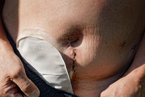 Bottom of stomach with a scar and staples through the tummy button vertically and an ostomy bag to the left