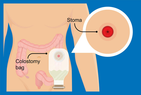 An anatomical graphic based diagram of a colostomy and colostomy bag