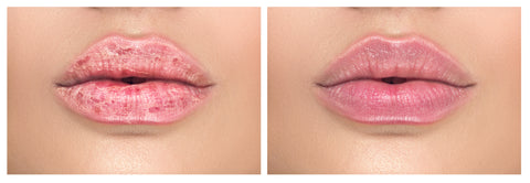Dry, sore lips on the left and normal, healthy lips on the right