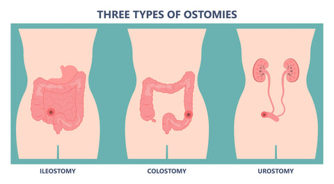 Dessin montrant une iléostomie, une colostomie et une urostomie (de gauche à droite)