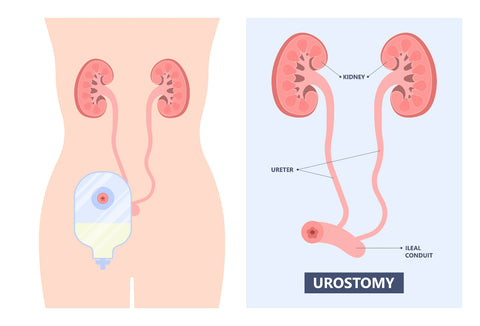 Urostomy diagram split into two: (left) diagram with urostomy bag containing urine and (right) organ diagram of urostomy