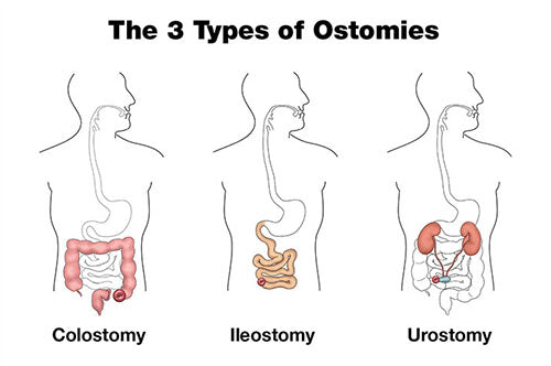 Diagram showing the 3 types of ostomy - colostomy, ileostomy and urostomy (from left to right)