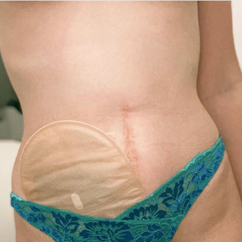Cropped image from below bust to top of thighs of a female showing her ileostomy bag tucked into blue lacy knickers with a stomach scar on show