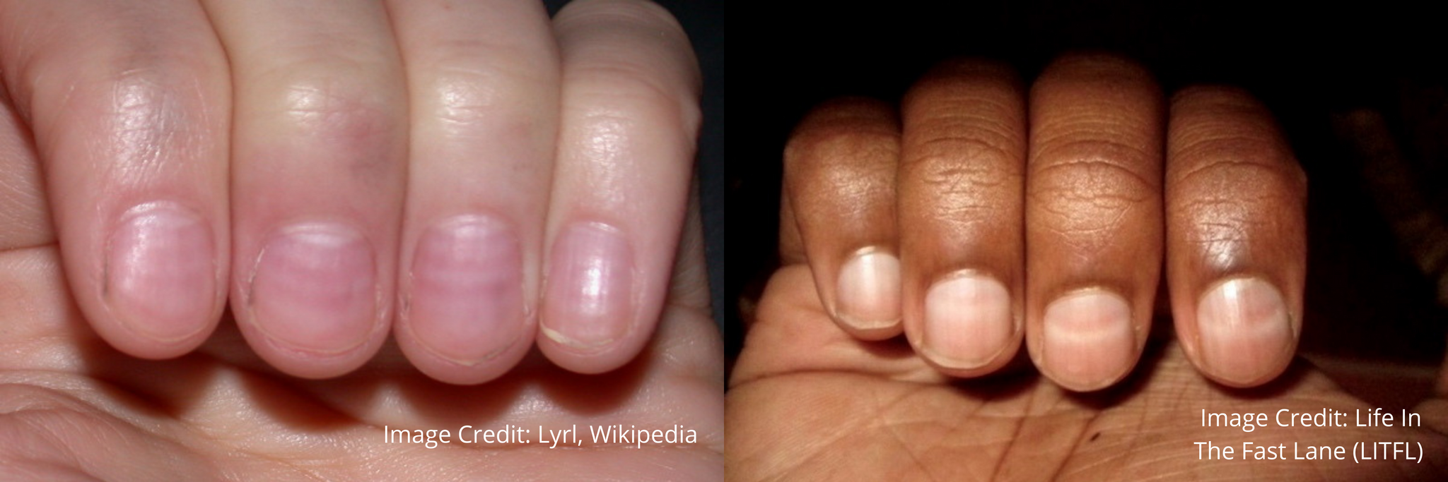 Why Do I Have White Spots on My Nails?