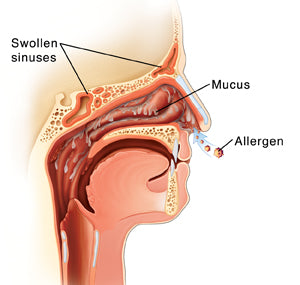 PollenGuard™ Allergy Relief Nasal Spray 