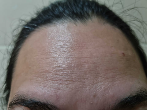 LineLess™ Forehead & Between Eyes Wrinkle Patch
