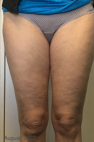 HerbalFusion™ Cellulite Targeting Patches
