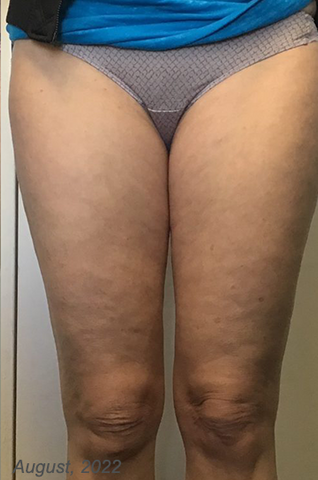 HerbalFusion™ Cellulite Targeting Patches 