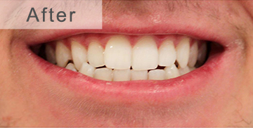 7 Days Teeth Whitening Powder