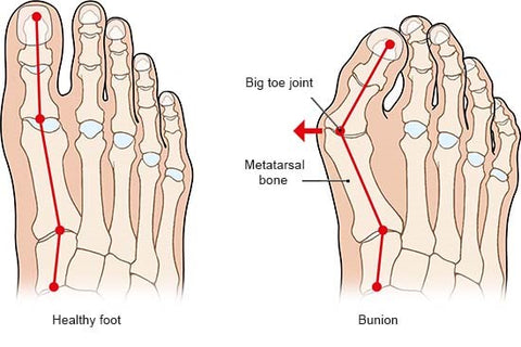 Feetin™ Bunion Relief Fit Patch 