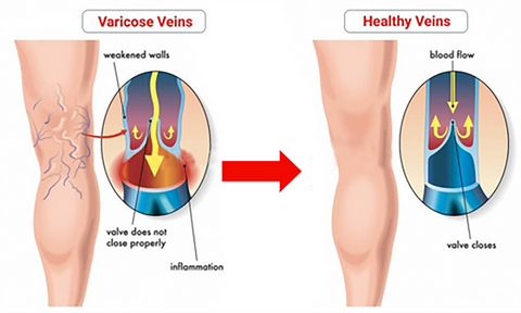 VascuClear™ Vein Therapy Cream