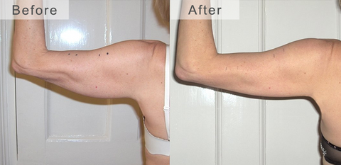 Infra-Red Graphene Arm Slimming Shaper