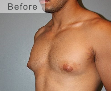 ChestSlim™ Gynecomastia Targeted Heating Balm
