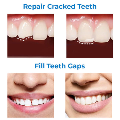 MEHARRY™ Professional Tooth Repair Shaping Teether Kit 