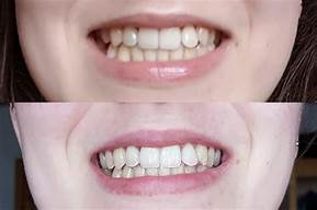 DazzleWhite Teeth Whitening Essence