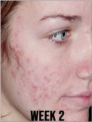 AUQUEST Salicylic Acid Acne Treatment Cream