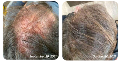 GFOUK™ Scalp Folliculitis Therapy Oil