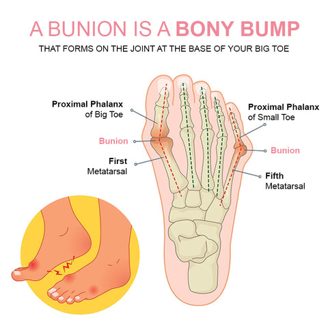 StrongJoints Bunion əleyhinə yamaqlar